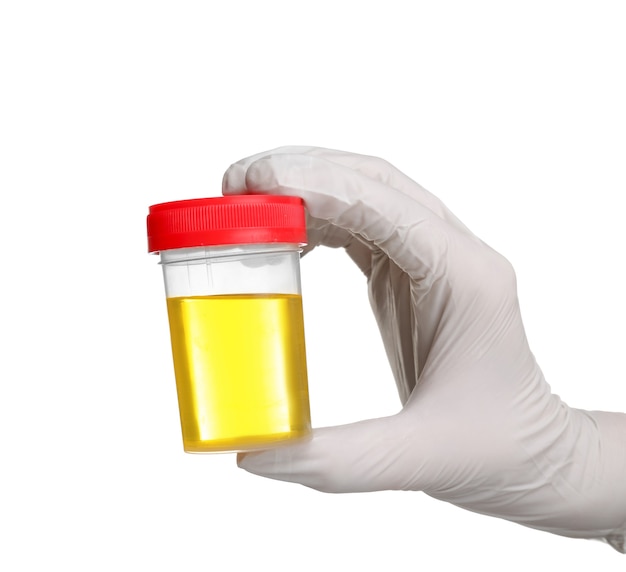 hand in white glove holding specimen cup with urine test on white surface