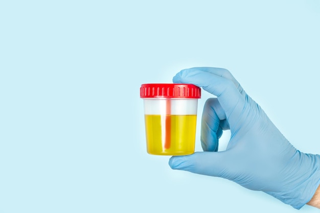 Hand with surgical glove holding a disposable medical cup for urine analysis