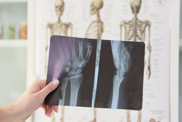 Hand of woman holding xray of wrist against skeletons in doctor office professional checkup of