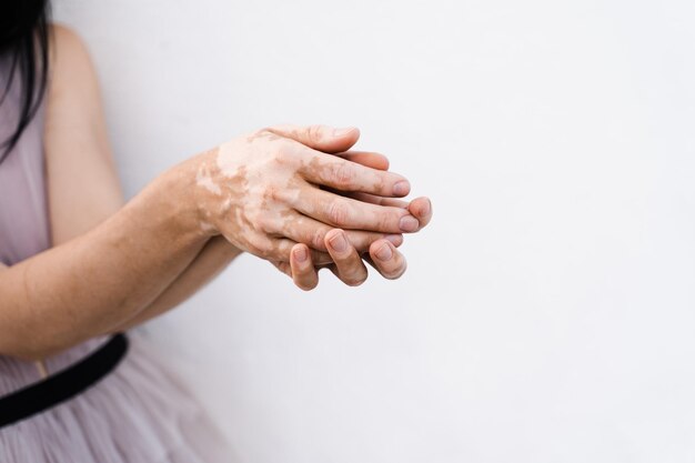 Handen met vitiligo huidpigmentatie op witte achtergrond close-up Lifestyle met seizoensgebonden huidziekten