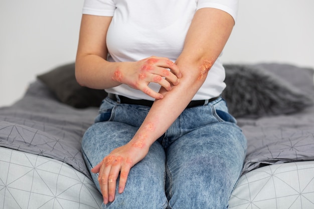 Foto handen van patiënt die aan psoriasis lijdt