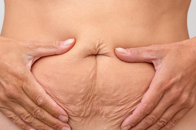 Photo hands on belly pressed skin to show sagging skin after diet and stretch marks after pregnancy