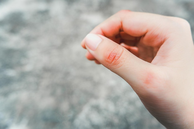 Foto mani e dita della donna con cicatrice cheloide concetto di salute della pelle di bellezza