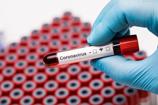 Hands holding covid19 test. Medical test-tube with blood samples