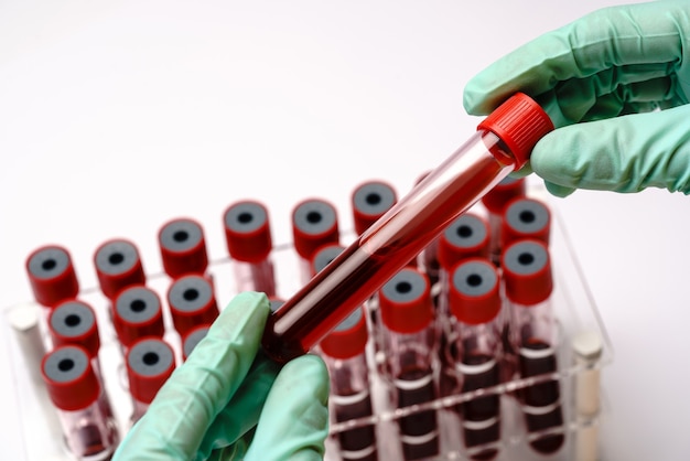 Photo hands of a lab technician with a test tube of blood sample and a rack with other samples on grey.