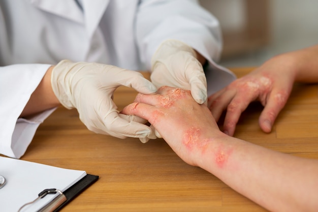 Photo hands of patient suffering from psoriasis