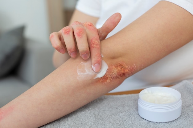 Hands of patient suffering from psoriasis