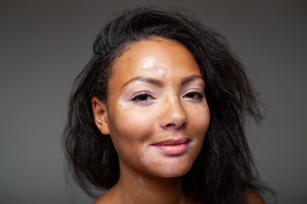 Foto fortunata donna nera con problema di pelle pigmentata da vitiligo