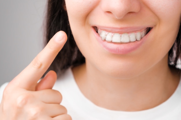 Happy woman with a perfect smile shows with finger on transparent aligners on her teeth