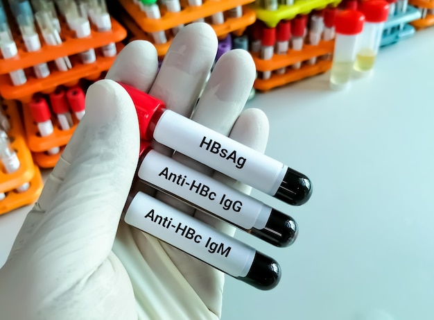 HBsAg Anti HBc IgG and Anti HBc IgM test or Hepatitis B Antigen and antibody testing