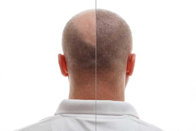 Photo the head of a balding man before and after hair transplant surgery a man losing his hair has become