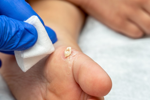 Healing treatment of cracked, dry wart, calluses on the child foot sole