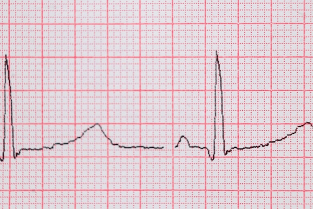 Электрокардиограмма сердца ЭКГ-карта на специальной бумаге. Концепция сканирования сердца, медицинское страхование, медицинское образование, обследование.