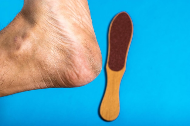 The heel of a man with roughened skin on the heel on a blue background