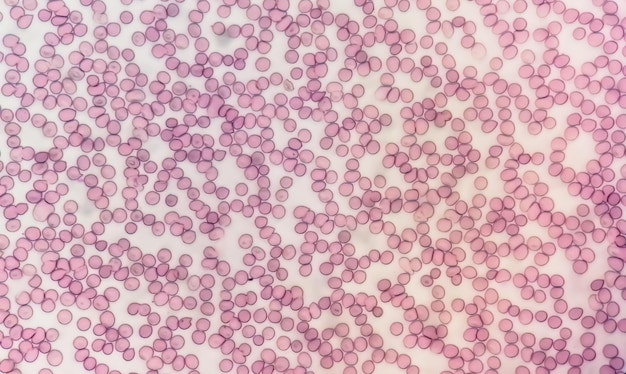 Hematological slide under microscopy showing thrombocytopenia. Extremely low level of platelet count