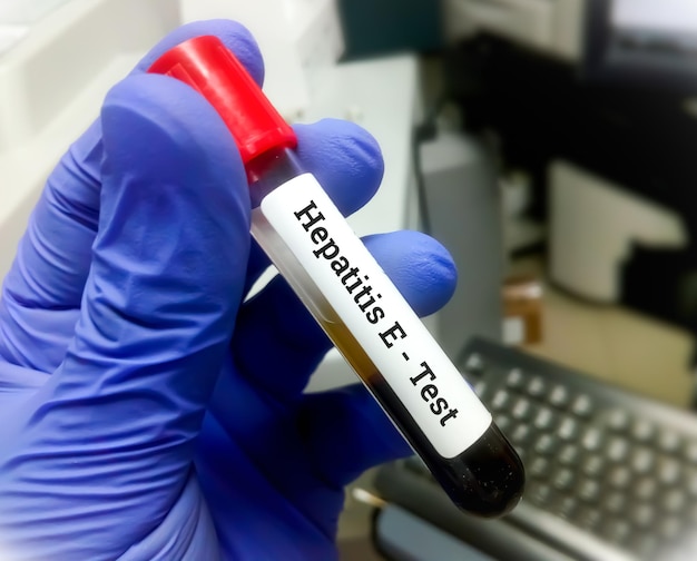 Premium Photo | Hepatitis e virus test for the diagnosis of hepatitis e  virus infection