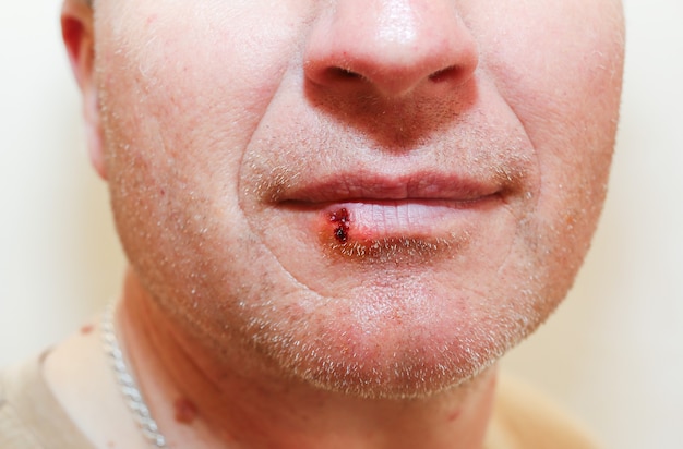 입술에 헤르페스 감염. 남자의 얼굴에 피가 묻은 상처. 의료 사진입니다.