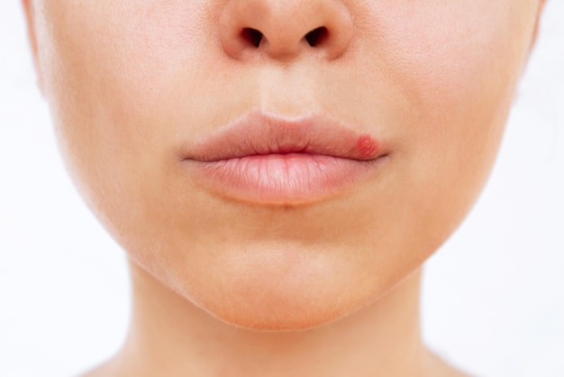 Herpes sul labbro. vesciche causate da virus sulla bocca di una giovane donna isolata su uno sfondo bianco
