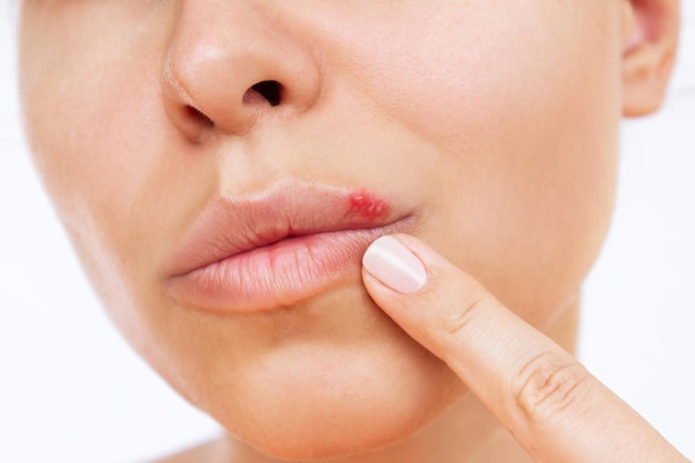 Herpes on the lip. Young woman points at blisters caused by virus on the mouth with her finger