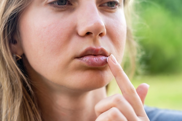 Photo herpes on the lips of young woman close up