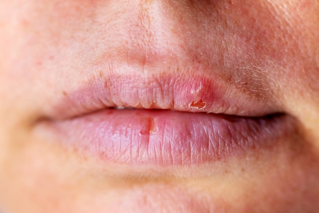 Herpes op de lip close-up macro.