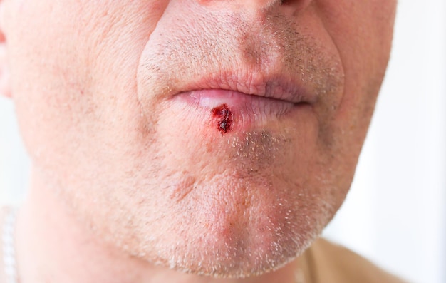 Herpesinfectie op de lippen Wond met bloed op het gezicht van de man Medische zorg foto
