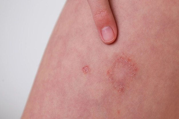 Het kind heeft allergische contactdermatitis op de huid