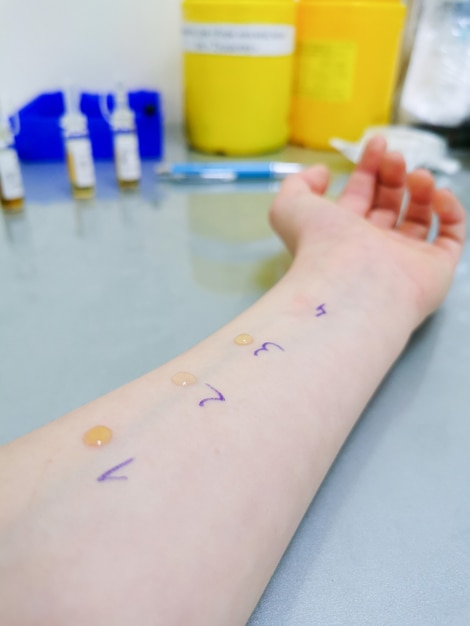 Het kind wacht op de uitslag van een huidprik-allergietest op zijn of haar arm