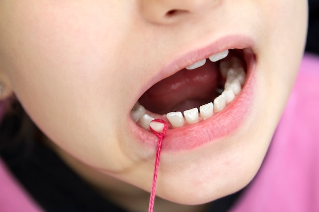 Het tandje van een baby uit een meisje trekken met een rood koord