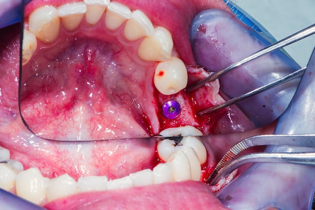 Het tandvlees wordt gehecht met een speciale floss bij de chirurgische incisie om plaats te bieden aan het tandheelkundige implantaat