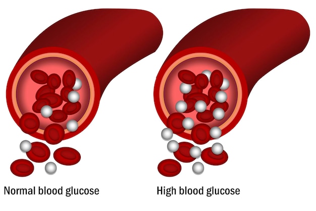 High blood glucose isolated with white background