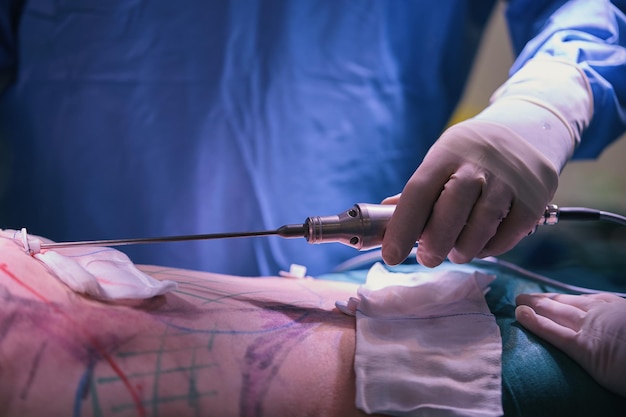 Foto high-definition liposuctie in de operatiekamer