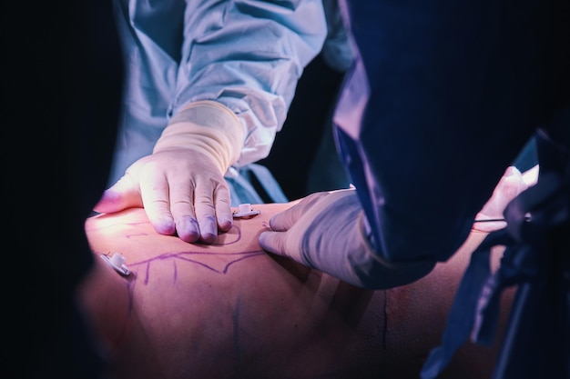 High definition liposuction in the operating room