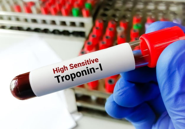 High sensitive TroponinI hs TroponinI for the early diagnosis of myocardial infraction