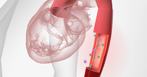 High volumes of lymphocytes macrophages and other immune cells infiltrate the inflamed aorta