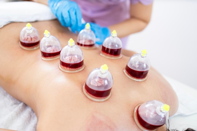 Hijama master performs a vacuum blood suction procedure on patient skin