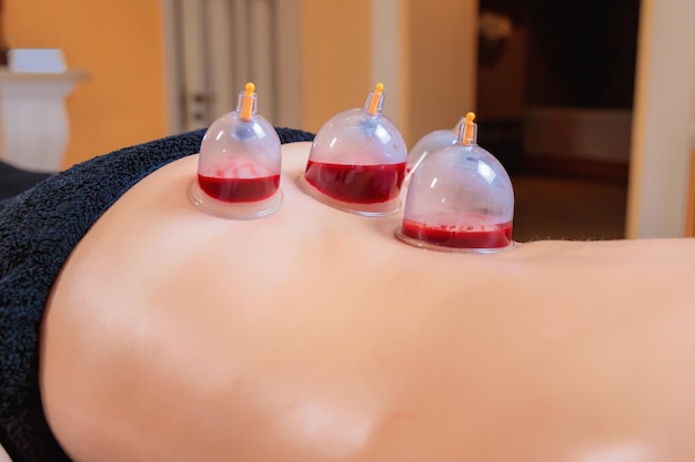 Foto un maestro di hijama esegue una procedura di aspirazione del sangue sotto vuoto per una ragazzina