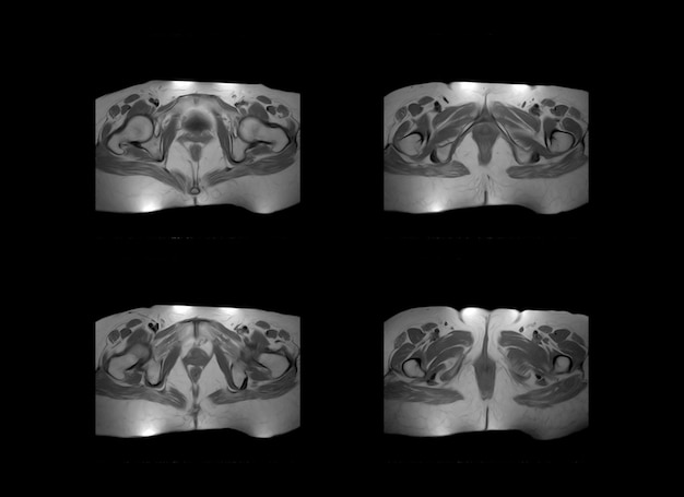 고관절 및 골반 MRI 엑스레이 이미지 및 CT 스캔