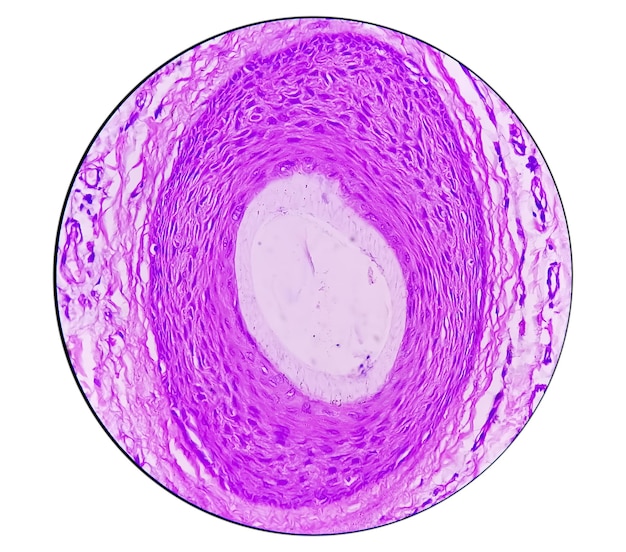 Calcinosis cutis를 보여주는 현미경으로 음낭 벽의 조직학적 생검. 음낭 석회화증.