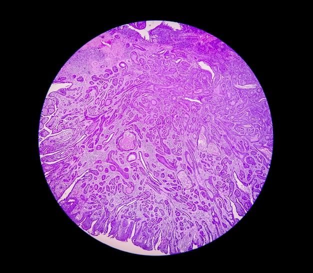 Histological slide under microscopy showing Pedunculated squamous papilloma