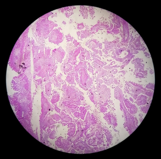 Histologie van gemetastaseerd papillair adenocarcinoom