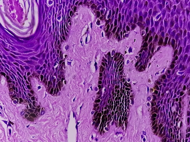 Histologische biopsie van scrotumwand onder microscopie die Calcinosis cutis toont. Scrotale calcinose.