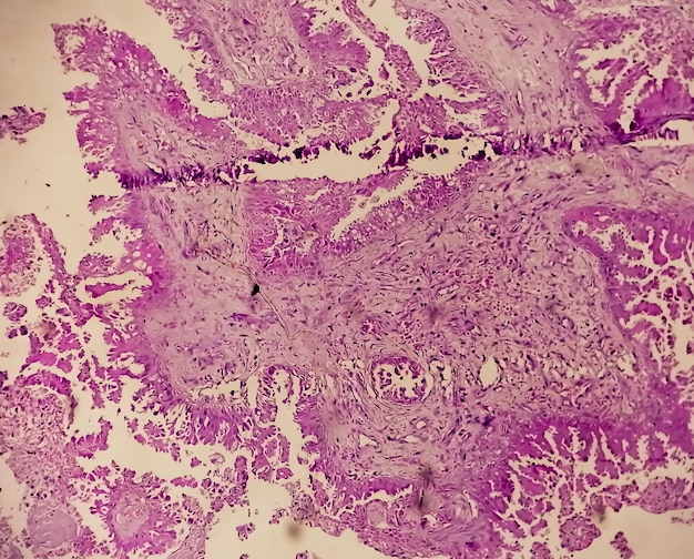 Photo histology of metastatic papillary adenocarcinoma