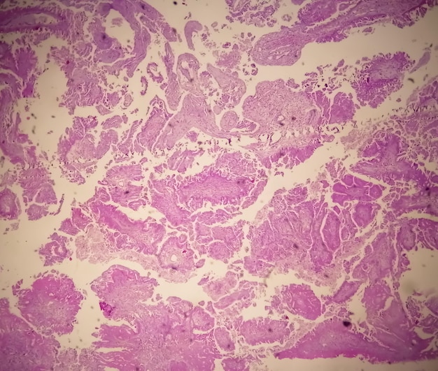 Histology of metastatic papillary adenocarcinoma