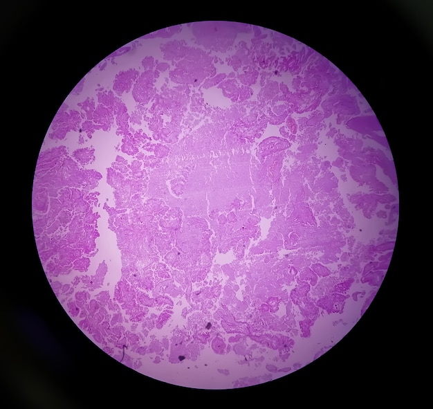 Histology of metastatic papillary adenocarcinoma