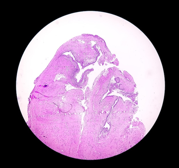 Histology of urachal cyst Photomicrograph of histological stained slide showing Urachal cyst