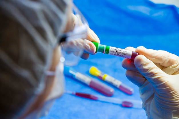 Hiv- en aids-infectie test, het gezicht van de arts en de hand met buis met bloed op de blauwe tafel. .