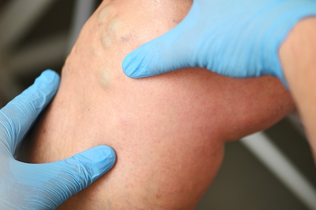 Photo hlebologist examines a patient with varicose veins on his leg