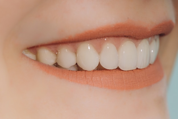 Hollywood smile with porcelain crowns and veneers