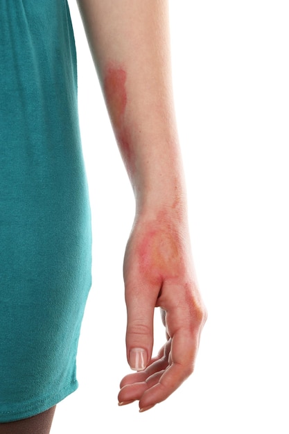 Foto ustioni orribili sulla mano femminile isolate su bianco